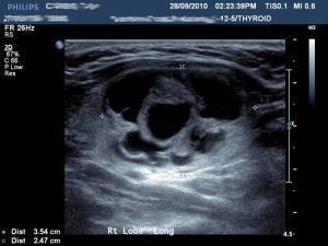 Таблица с нормами размеров щитовидной железы по УЗИ у детей и причины отклонений показателей