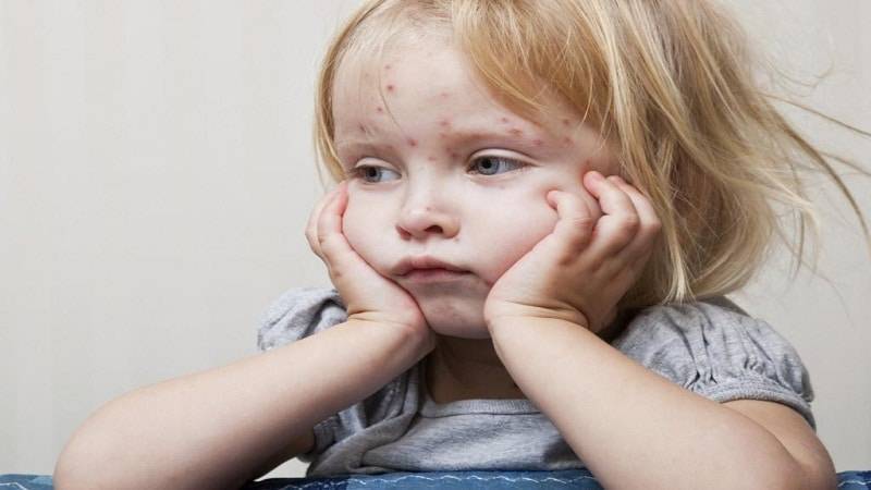 Фукорцин для детей: инструкция по применению при стрептодермии, ветрянке, опрелостях