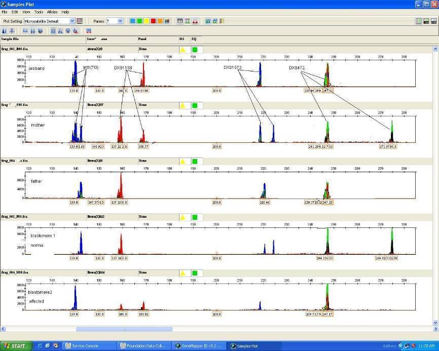 ПГД эмбриона: для чего проводится при ЭКО, как проходит генетический анализ?