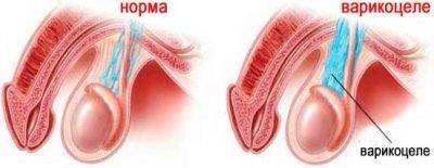 Эритроциты, лецитиновые зерна и клетки эпителия в спермограмме: что это означает?