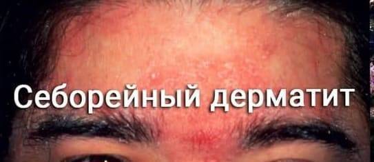 Средства для увлажнения кожи ребенка - лечение атопического дерматита народной медициной