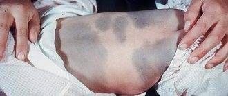 Монгольское пятно у новорожденных (монголоидное): фото, причины, значение