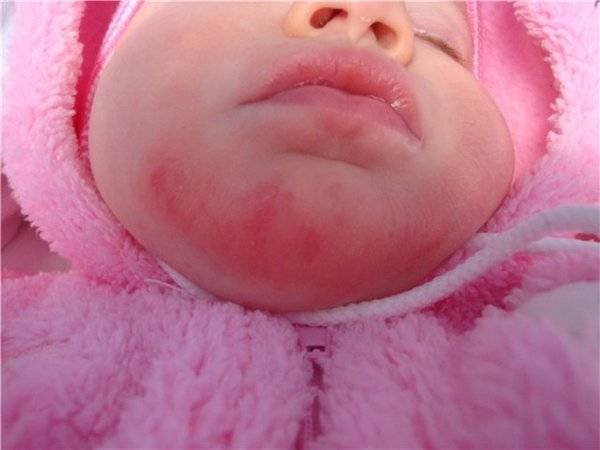 Сыпь под носом у ребенка фото с пояснениями