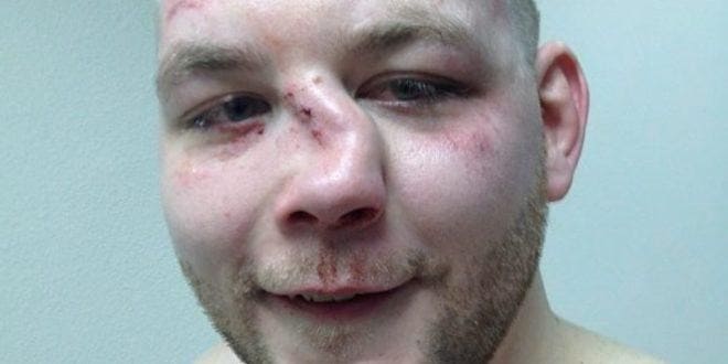 Перелом носа у ребенка: симптомы и признаки с фото, способы определения травмы