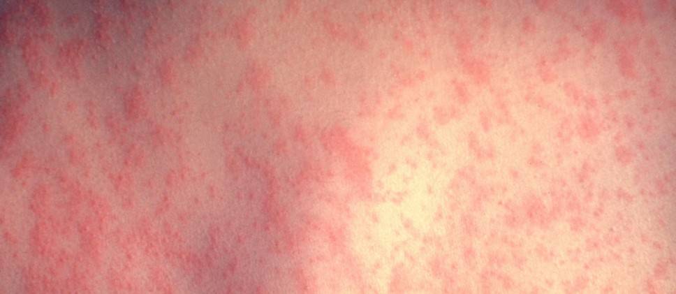 Сыпь после температуры у ребенка: фото, причины и лечение (Комаровский)