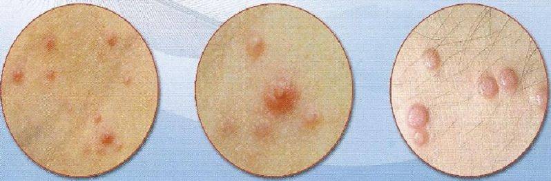 Контагиозный моллюск у детей: фото на коже, лечение и удаление на разных стадиях болезни