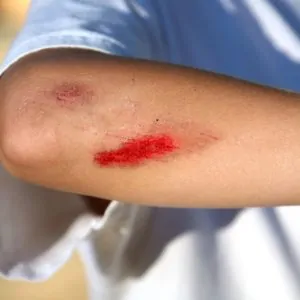 Мазь для заживления ран у детей: средства для обработки ссадин на коже