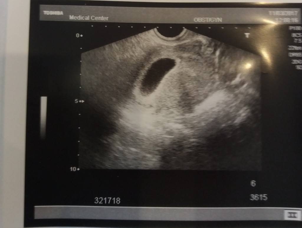 Пустое плодное яйцо или анэмбриония: причины, симптомы и методы диагностики отсутствия эмбриона