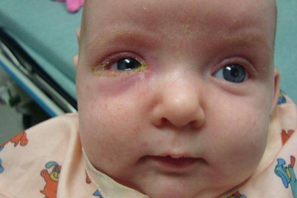 У ребенка красные глаза: причины и лечение, сопутствующие симптомы - гной, аллергия