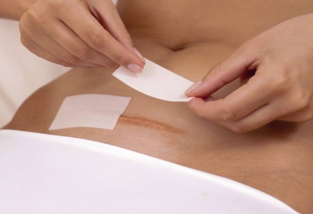 Выделения после кесарева сечения: сколько длятся, какими должны быть в норме?