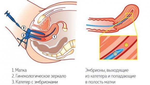 Как вести себя после криопереноса 5-дневных эмбрионов, какими будут ощущения?