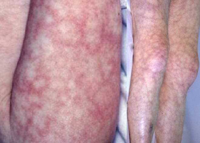 Мраморная кожа у грудничка: причины мраморности кожных покровов и лечение