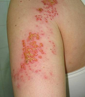 Опоясывающий лишай у детей - симптомы и лечение вируса герпес Зостер