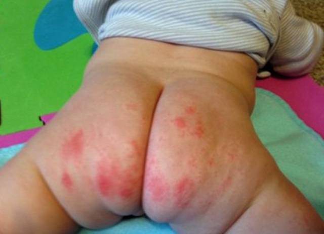 Сыпь у ребенка на попе - фото прыщей с пояснениями, причины аллергии и сухой кожи, лечение