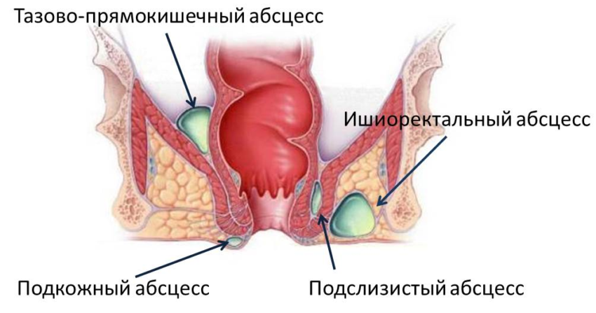 Боль в заднем проходе при месячных: причины, сопутствующие симптомы и лечение
