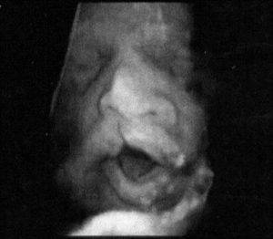 Волчья пасть у детей и заячья губа: причины патологий, фото до и после операции