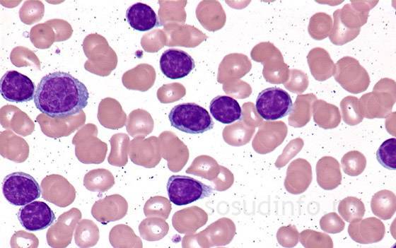 Лейкоз: симптомы у детей, признаки лейкемии в острой стадии, анализы и лечение