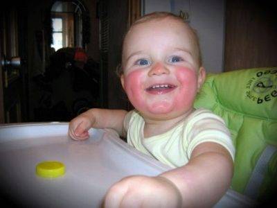 Пеленочный дерматит у детей: симптомы с фото и лечение по Комаровскому