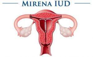 Удаление внутриматочной спирали: когда убирают ВМС, какие могут быть последствия?