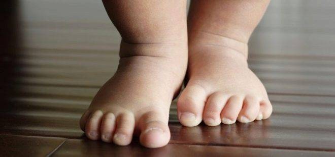 Варусная деформация стопы у детей ???? - фото и симптомы, способы лечения, подбор обуви