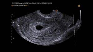 Пустое плодное яйцо или анэмбриония: причины, симптомы и методы диагностики отсутствия эмбриона