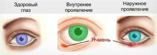 Как лечить ячмень на глазу у ребенка в домашних условиях: быстрые способы терапии чирей