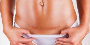 Спина болит после кесарева сечения: причины, способы избавления от боли