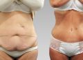 Абдоминопластика: восстановление красоты и здоровья живота