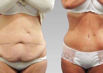 Абдоминопластика: восстановление красоты и здоровья живота