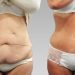Абдоминопластика: восстановление красоты и здоровья живота