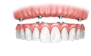 Имплантация All-on-4: инновационное решение для зубных протезов
