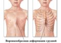 Причины и патогенез вогнутой грудной клетки у детей