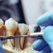 Костная пластика при имплантации зубов: основные аспекты и преимущества