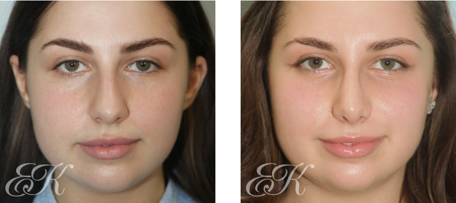 Риносептопластика: гармония эстетики и здоровья