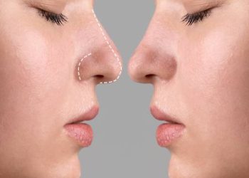 Риносептопластика: гармония эстетики и здоровья
