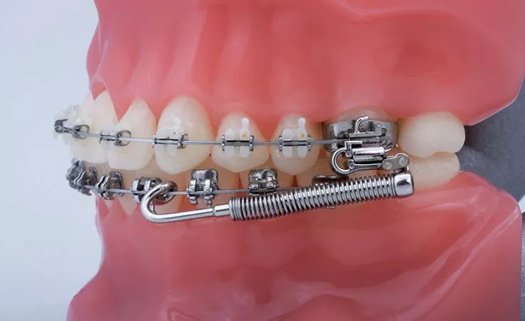 Аппарат Гербста: Принципы работы и применение в ортодонтии