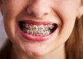 Можно ли установить брекеты в рассрочку: все способы оплаты ортодонтического лечения