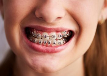Можно ли установить брекеты в рассрочку: все способы оплаты ортодонтического лечения