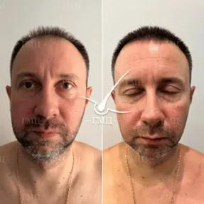 Пересадка волос СПБ