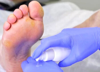 УДАЛЕНИЕ МОЗОЛЕЙ В ЦЕНТРЕ СОВРЕМЕННОЙ ПОДОЛОГИИ: ЭФФЕКТИВНО, БЕЗОПАСНО, БЕЗ БОЛИ