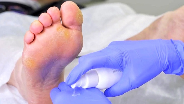 УДАЛЕНИЕ МОЗОЛЕЙ В ЦЕНТРЕ СОВРЕМЕННОЙ ПОДОЛОГИИ: ЭФФЕКТИВНО, БЕЗОПАСНО, БЕЗ БОЛИ