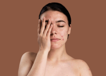 Послеродовое акне: безопасный план восстановления кожи для молодых мам