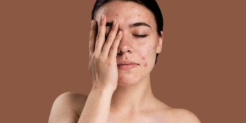 Послеродовое акне: безопасный план восстановления кожи для молодых мам