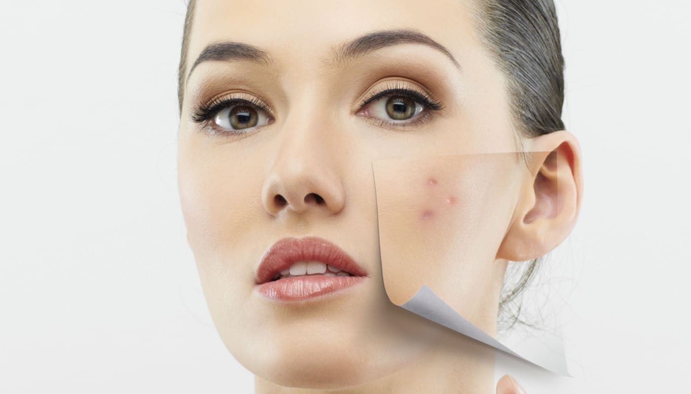 Послеродовое акне: безопасный план восстановления кожи для молодых мам