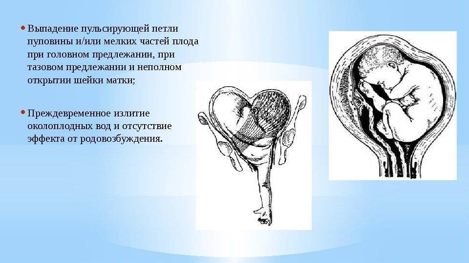Обвитие пуповиной однократное, двойное и тройное: насколько опасно?