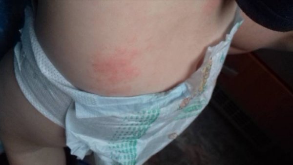 Раздражение в интимной зоне у ребенка (девочки), покраснение и зуд: причины