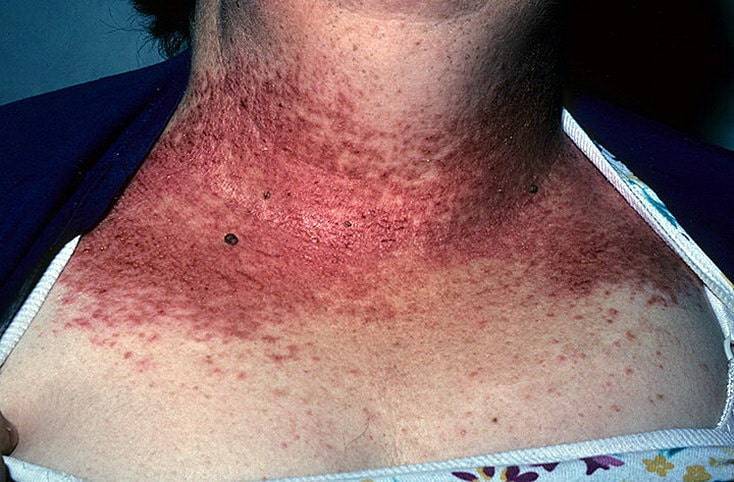 Ихтиоз кожи у детей: опасно ли это заболевание для новорожденных, что делать и как лечить?