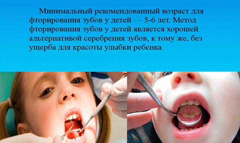 Серебрение зубов у детей — фото до и после, фторирование как альтернатива