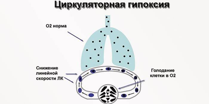 Отек головного мозга у новорожденных - возможные последствия для ребенка