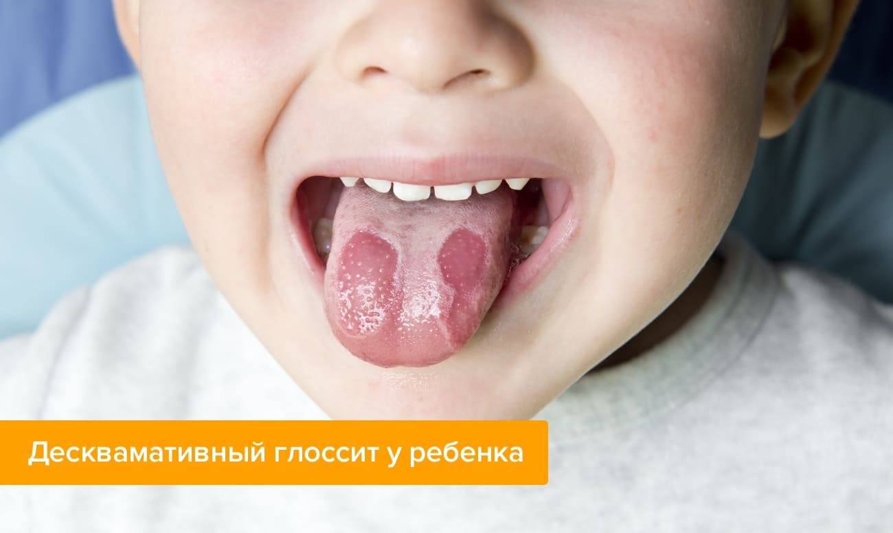 Географический язык у ребенка: причины возникновения, лечение, что делать